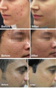 Acne littekens voor en na een microneedling behandeling