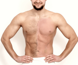 Laser hair removal: an ideal solution for men too! - Skincenters