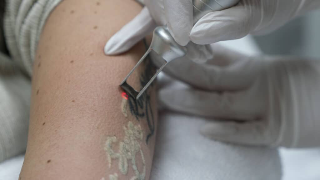 Tattoo verwijdering met Picoplus laser van Lutronic close-up
