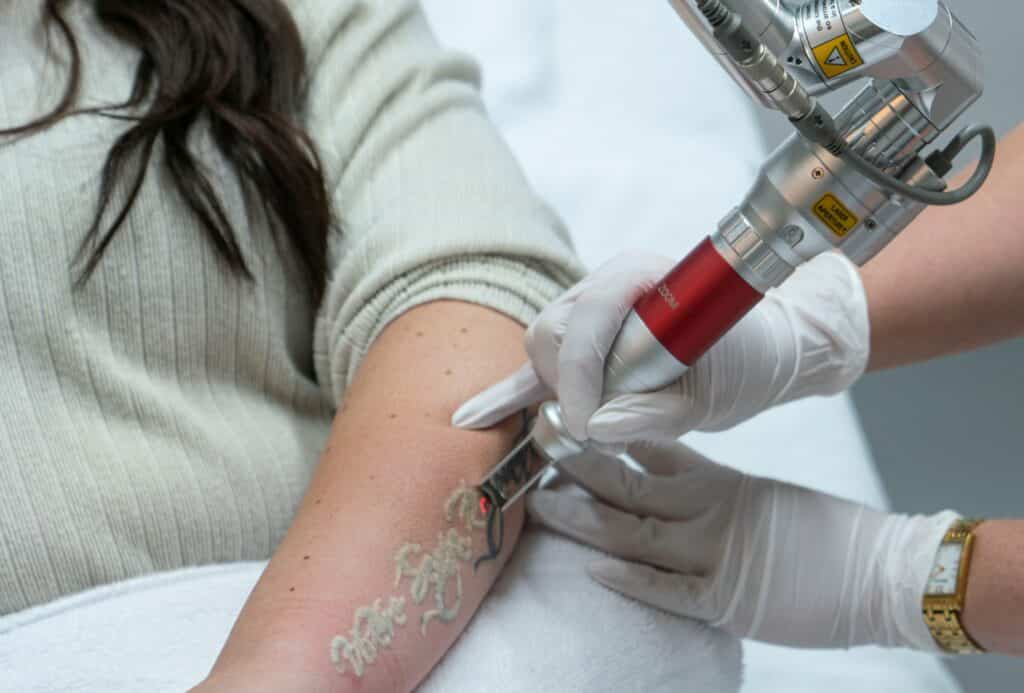 tattoo verwijdering van tattoo op arm met het Picoplus toestel van Lutronic.