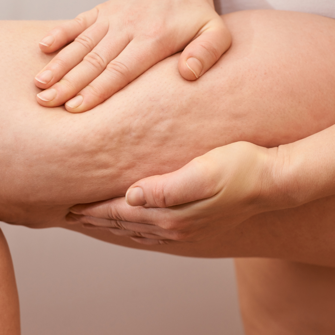 cellulite