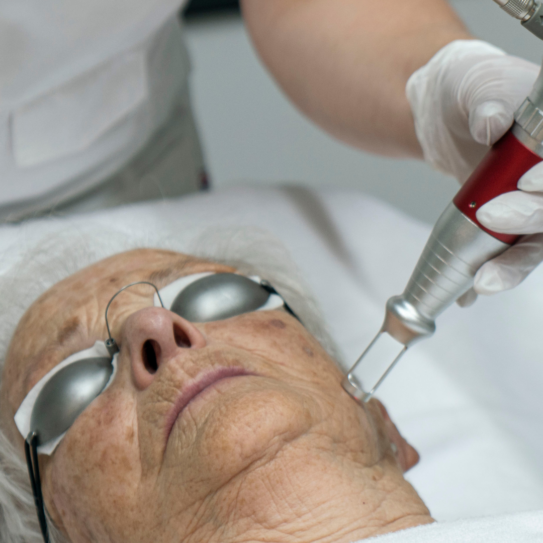 laserbehandeling voor verwijderen pigmentvlekken