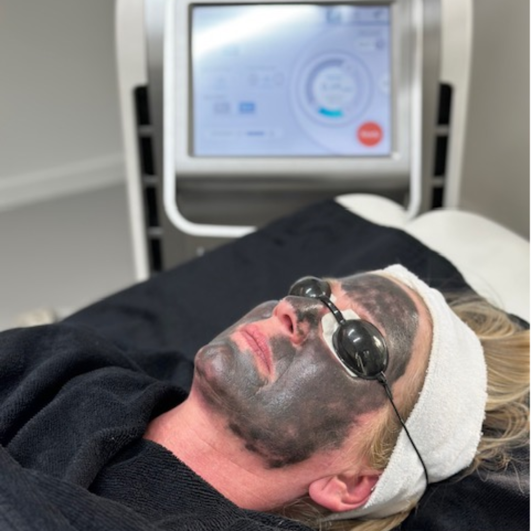 Traitement par peeling au carbone