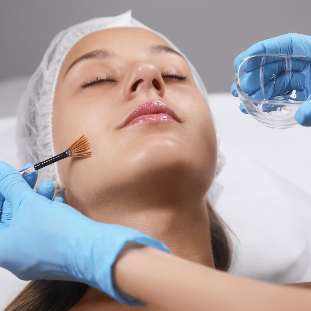 chemische peeling TCA