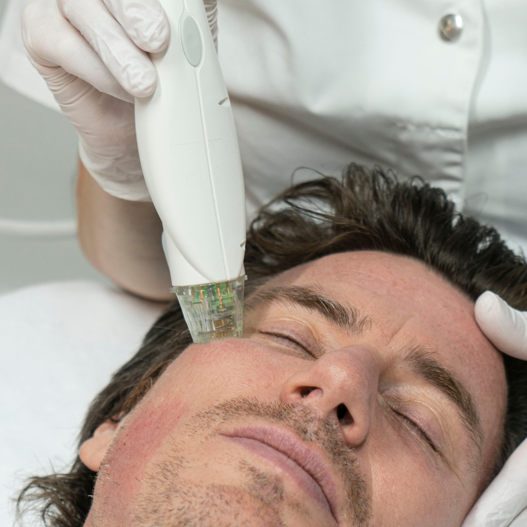 traitement rf microneedling visage