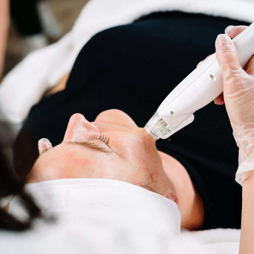 traitement rf microneedling visage