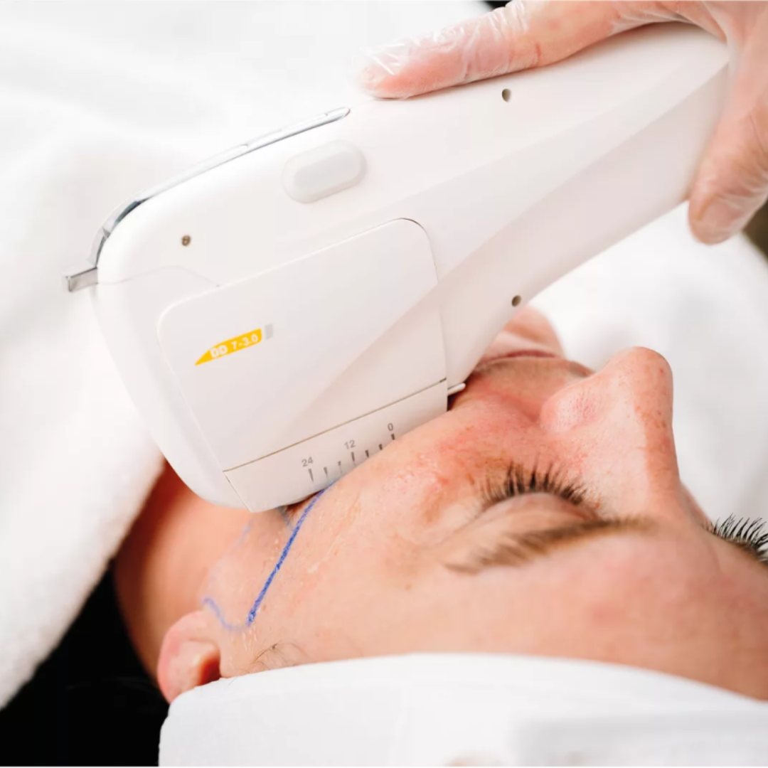 HIFU treatment with relift from Zimmer