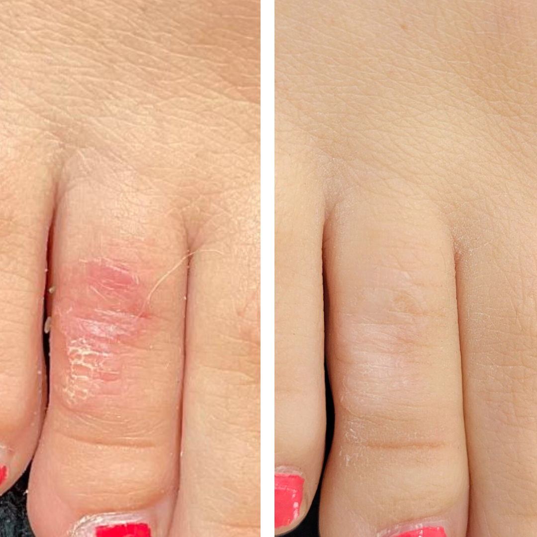 cicatrices avant et après