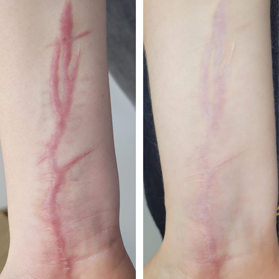 cicatrices avant et après