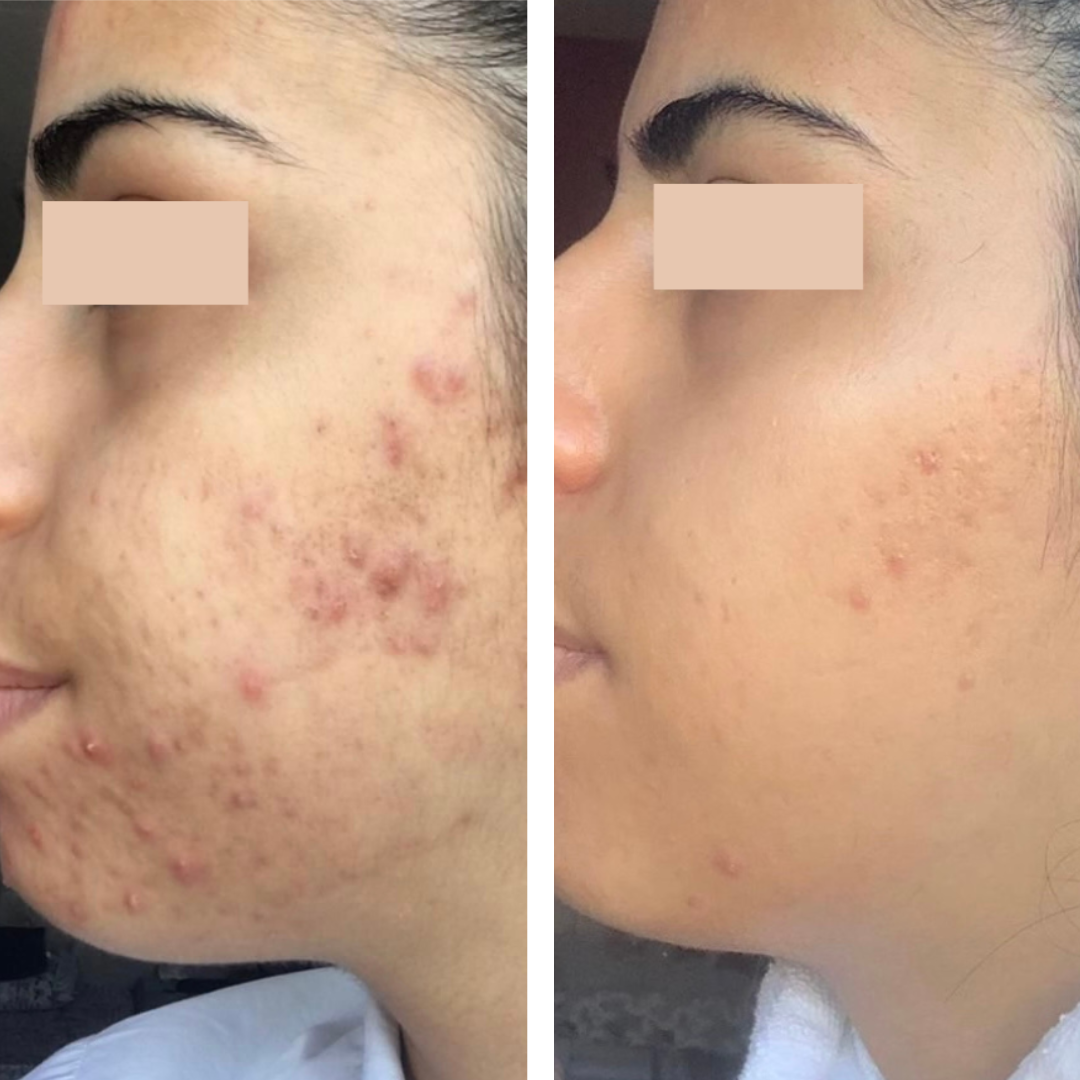 resultaten acne behandeling