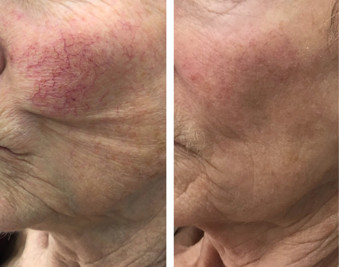 resultaat couperose behandeling