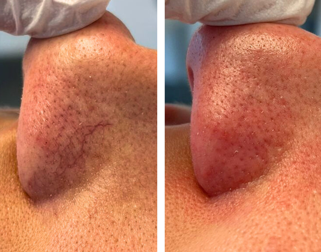 resultaat couperose behandeling