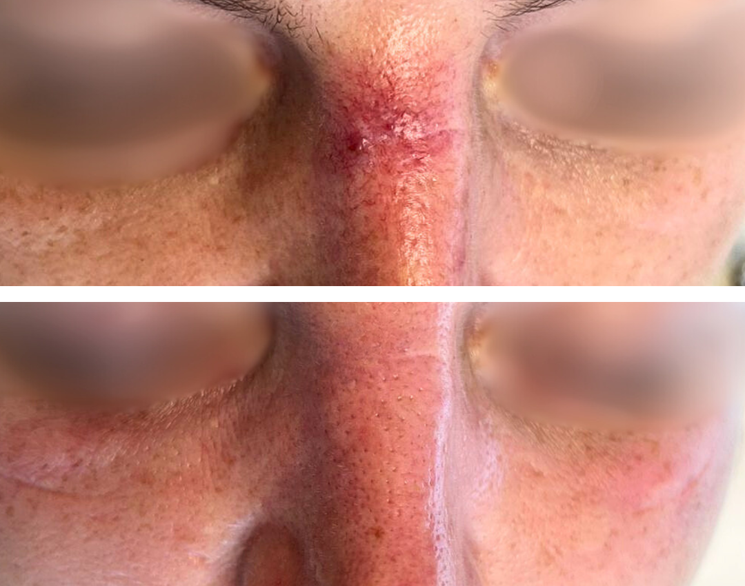 resultaat couperose behandeling