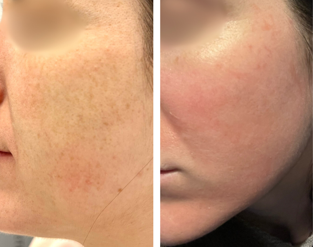 voor en na pigmentvlekken