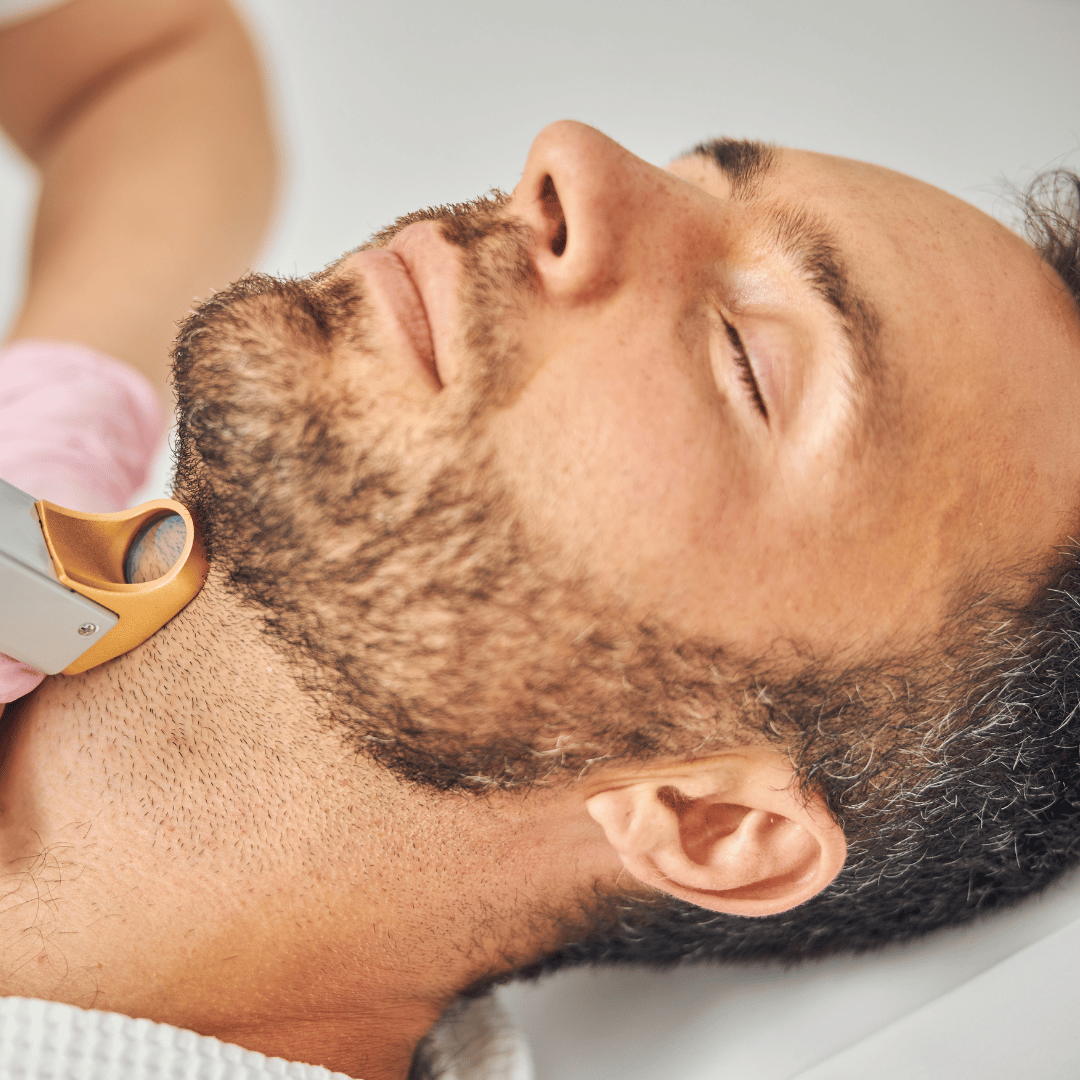 Épilation laser de la barbe
